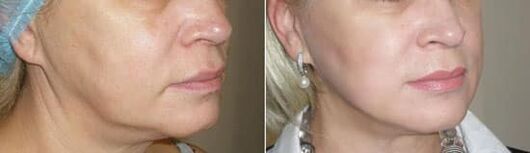 Foto dopo aver applicato la procedura