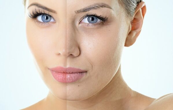 Indicazioni per il ringiovanimento frazionario